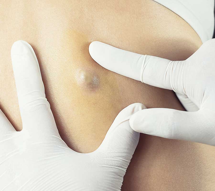 Cyst Removal London