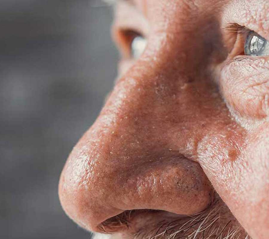Rhinophyma Treatment London