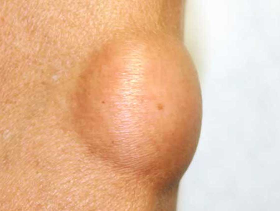 Lipoma Removal London