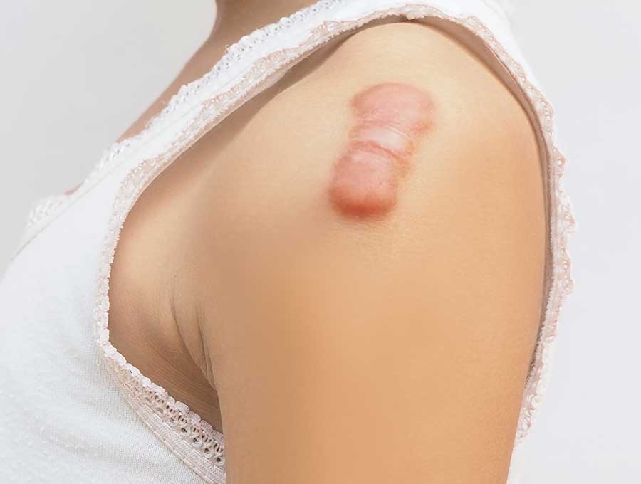 Keloid Removal London
