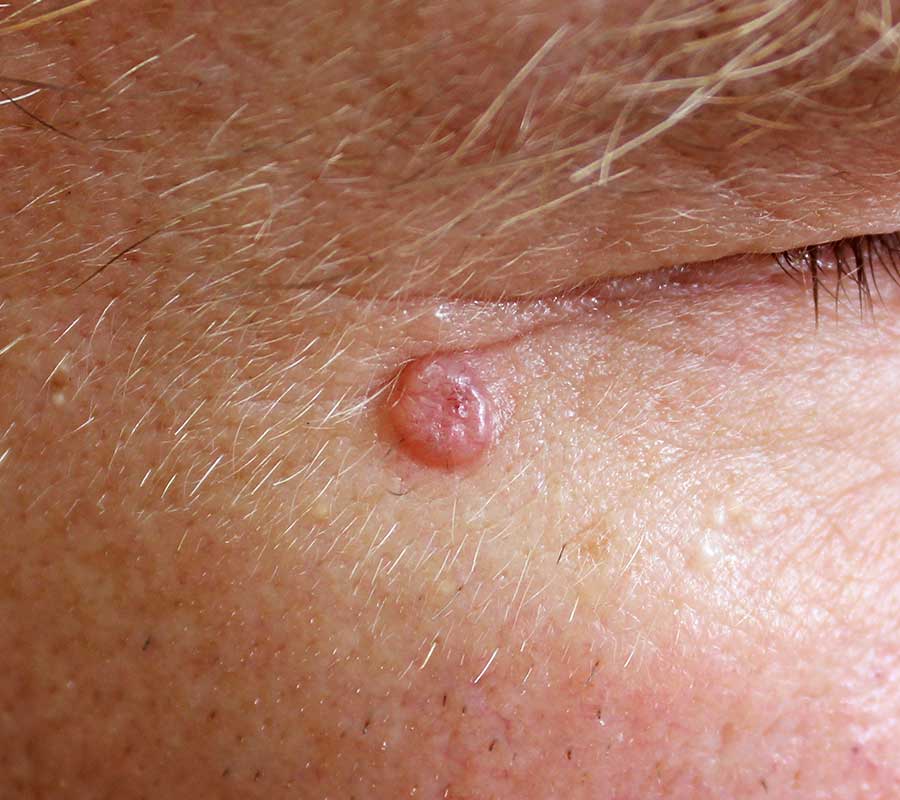 Basal Cell Carcinoma Treatment London